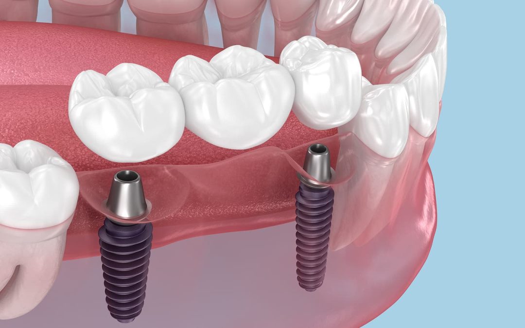 Vienmomentė dantų implantacija – ką svarbu žinoti?